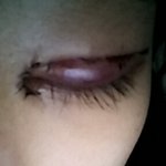 [<b>쌍수후</b>] <b>쌍수</b> <b>후</b>