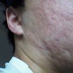 [여드름흉터] 여드름흉터때매 모든게 힘드네요.. 사진(혐)