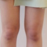 [댓글부탁] 사진0)이렇게 휜다리 교정될까요?ㅠㅠ