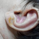 피부에노란각질?<b>딱지</b>?ㅜ