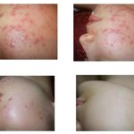 [알려주세요] [강릉 피부샵]여드름 극<b>복기</b>^^