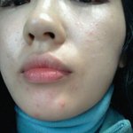 [봐주세요] 신촌여드름, 해들인한의원 좀 짱인듯~