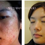 여드름한<b>의원</b> 해들인 치료후기