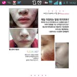 [여드름] 80000원으로 7일만에 여드름낫는법