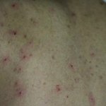 [봐주세요] 등여드름 치료 <b>흉터</b> 제거까지..1차치료~