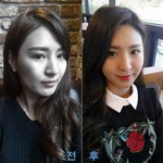 두드림성형외과 <b>안면</b>윤곽 진짜 잘하긴 하는듯