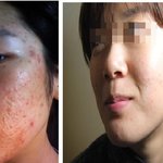 <b>신촌</b>여드름치료잘하는 해들인
