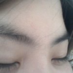 <b>쌍수</b> <b>후</b> 6개월...