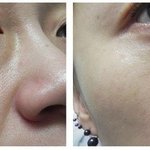 피부과 시술 필요없음 <하얀연탄> <b>천연</b>과일팩레시피 후기