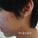 홍대 여드름치료한의원,해들인