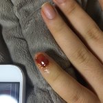 [꼭조언부탁] <b>손톱</b>이 빠졋을때 어떻게해야하죠?
