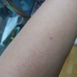 <b>닭살</b> 때문에 진짜 미치겠어요ㅠㅠ..
