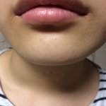 (사진有) 턱이 <b>사각</b>턱인데 앞턱 t골절만 하고 브이라인 수술은 안해도...