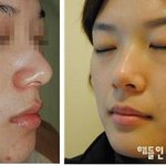 여드름한의원 치료의 <b>핵심</b>?