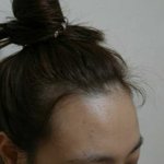 [봐주세요] 여자 헤어라인 <b>모발</b>이식 후기염!