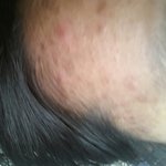 [조언부탁] 혐오)여드름<b>흉터</b> 심각해요