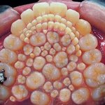 <b>hyper</b> dontia 라는 병이라네요?