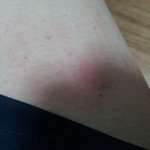 모기?<b>진드기</b>? 뭐에 물린 자국이죠??