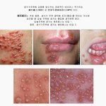 [공포베스트] [약혐]헤르페스 <b>바이러스</b>를 아세요?