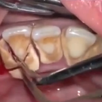 [공미니] 약혐] <b>치석</b>제거 영상