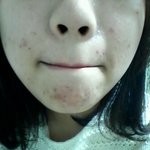 [댓글부탁] 저보다여드름심한사람...ㅜㅠ?