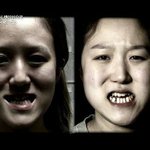 렛미인 성형수술 <b>전후</b>:쌍둥이 자매의 변신