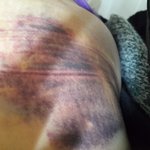 후기) ppc 부작용일까요? 봐주세요!!ㅠㅠㅠㅠ