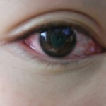 눈<b>충혈</b>