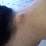 <b>뒷목</b>에 혹생겼는데 이거 제거해야되지~~