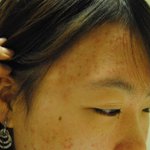 신촌한의원에서 여드름치료 받았는데요