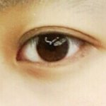 눈위에 물<b>사마귀</b>