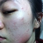 신촌피부과 해들인 한방여드름치료
