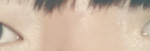 쌍커<b>풀</b> 수술 ㅜㅜ