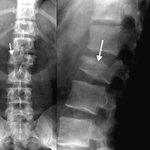 척추압박골절이 발생한 경우 후유장해진단이 가능할까요??