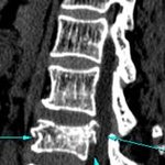척추압박골절이 발생하면 후유증이 남을까요?