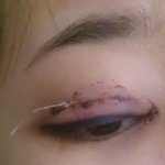 당일 쌍수 <b>실밥</b>풀림