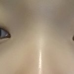 절개쌍수 1년후 제눈어떡하죠