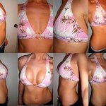 [19] 65a->65e 성형가슴이요