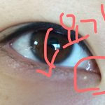 눈밑 <b>좁쌀</b>여드름인가요