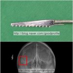 [성형수술] 얼굴뼈 속안에 부러진 칼날이 4년동안?