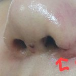 [꼭조언부탁] 제 코좀 봐주세요 급합니다.ㅠㅠ<사진 있습니다>