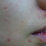 여드름 따위, 비오템 <b>퓨어</b>펙트로 깔끔하게 없앴쥐!