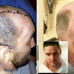 [공포베스트] 펀치 한방에 두개골 <b>함몰</b>..ㄷㄷ