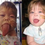 [공포베스트] 혀가 계속 자라는 희귀병 4살 소녀