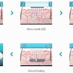 잠실 <b>인트</b>라셀 잘하는곳 강남이지함피부과 추천