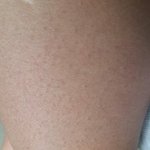 [댓글부탁] <b>닭살</b>피부없애기 치료 받았어요~~~!!!!