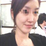 [진심개빡침] 지방이식후  괴물같은 내얼굴