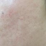 모공<b>축소</b>시술 받았어요~ 후기 남기고 가요!