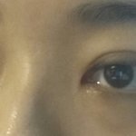 <b>쌍수</b>붓기4개월째ㅠㅠ한번봐주세요 심각