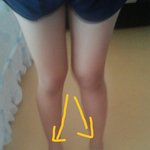 [사진ㅇ] 다리가휘었어요ㅜ